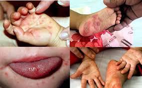 Bệnh chân tay miệng theo đông y