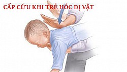 Cấp cứu hóc dị vật ở trẻ