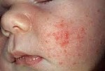 Bệnh viêm da mụn mủ truyền nhiễm
